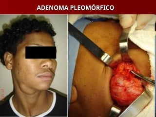 ADENOMA PLEOMÓRFICO
ADENOMA PLEOMÓRFICO
 