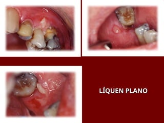 LÍQUEN PLANO
LÍQUEN PLANO
 