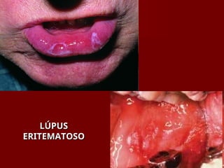 LÚPUS
LÚPUS
ERITEMATOSO
ERITEMATOSO
 