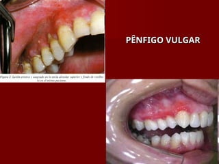 PÊNFIGO VULGAR
PÊNFIGO VULGAR
 