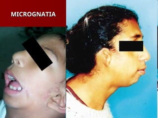 MICROGNATIA
MICROGNATIA
 