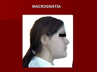 MACROGNATIA
MACROGNATIA
 