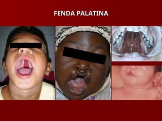 FENDA PALATINA
FENDA PALATINA
 