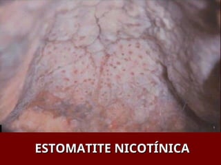 ESTOMATITE NICOTÍNICA
ESTOMATITE NICOTÍNICA
 