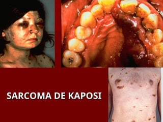 SARCOMA DE KAPOSI
SARCOMA DE KAPOSI
 
