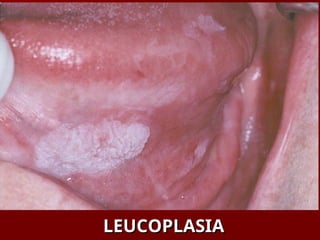 LEUCOPLASIA
LEUCOPLASIA
 