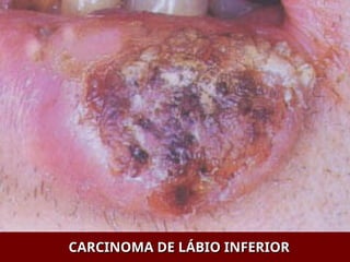CARCINOMA DE LÁBIO INFERIOR
CARCINOMA DE LÁBIO INFERIOR
 