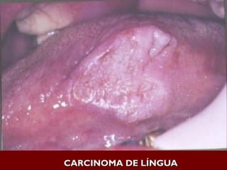 CARCINOMA DE LÍNGUA
CARCINOMA DE LÍNGUA
 