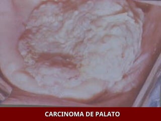 CARCINOMA DE PALATO
CARCINOMA DE PALATO
 