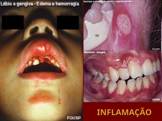 INFLAMAÇÃO
INFLAMAÇÃO
 