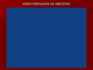 VIDEO DRENAGEM DE ABSCESSO
VIDEO DRENAGEM DE ABSCESSO
 