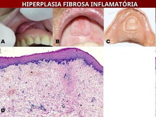 HIPERPLASIA FIBROSA INFLAMATÓRIA
HIPERPLASIA FIBROSA INFLAMATÓRIA
 