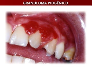 GRANULOMA PIOGÊNICO
GRANULOMA PIOGÊNICO
 