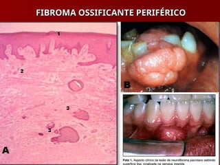 FIBROMA OSSIFICANTE PERIFÉRICO
FIBROMA OSSIFICANTE PERIFÉRICO
 