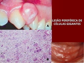 LESÃO PERIFÉRICA DE
LESÃO PERIFÉRICA DE
CÉLULAS GIGANTES
CÉLULAS GIGANTES
 