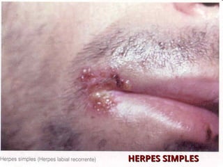 HERPES SIMPLES
HERPES SIMPLES
 