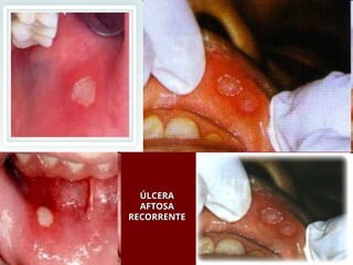 ÚLCERA
ÚLCERA
AFTOSA
AFTOSA
RECORRENTE
RECORRENTE
 