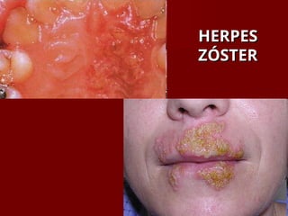 HERPES
HERPES
ZÓSTER
ZÓSTER
 