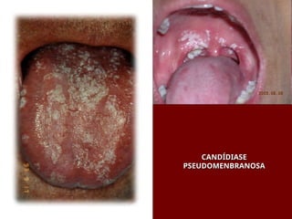 CANDÍDIASE
CANDÍDIASE
PSEUDOMENBRANOSA
PSEUDOMENBRANOSA
 