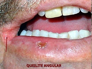 QUEILITE ANGULAR
QUEILITE ANGULAR
 