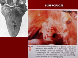 TUBERCULOSE
TUBERCULOSE
 