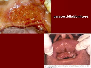 paracoccidioidomicose
paracoccidioidomicose
 