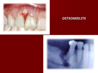 OSTEOMIELITE
OSTEOMIELITE
 