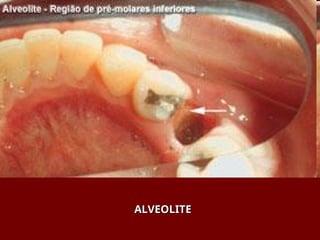ALVEOLITE
ALVEOLITE
 