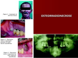OSTEORRADIONECROSE
OSTEORRADIONECROSE
 