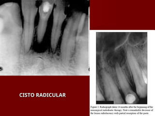 CISTO RADICULAR
CISTO RADICULAR
 