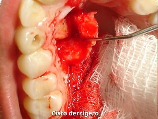 Cisto dentígero
Cisto dentígero
 