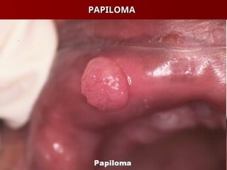 PAPILOMA
PAPILOMA
 