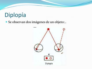 Diplopía
 Se observan dos imágenes de un objeto:..
 
