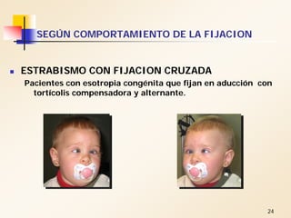 24
SEGÚN COMPORTAMIENTO DE LA FIJACION
ESTRABISMO CON FIJACION CRUZADA
Pacientes con esotropia congénita que fijan en aducción con
tortícolis compensadora y alternante.
 