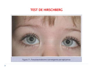 Hirschberg Test Normal estrabismo-y neuro clasas de oftalmologia | PPTX