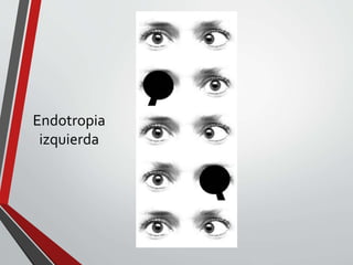 Endotropia
izquierda
 