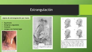 Estrangulación
signos de estrangulación por mano
• Equimosis
• Estigmas ungueales
• Cianosis
• Lengua con hemorragia
 