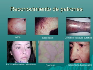 Reconocimiento de patrones

Acné

Lupus eritematoso sistémico

Escabiasis

Psoriasis

Complejo vásculo-cutáneo

Carcinoma basocelular

 