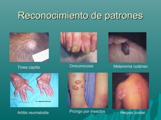 Reconocimiento de patrones

Tinea capitis

Onicomicosis

Artitis reumatoide

Prúrigo por insectos

Melanoma cutáneo

Herpes zoster

 