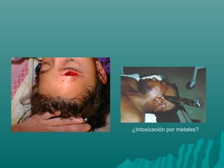 ¿Intoxicación por metales?

 