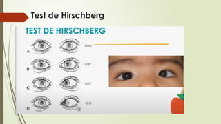 Hirschberg Test Normal ESTRABISMO OFTALMOLOGIA ALTERACION DE MOE | PPTX