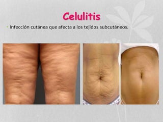 Celulitis
• Infección cutánea que afecta a los tejidos subcutáneos.
 