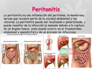 Peritonitis
La peritonitis es una inflamación del peritoneo, la membrana
serosa que recubre parte de la cavidad abdominal y las
vísceras. La peritonitis puede ser localizada o generalizada, y
puede resultar de la infección (a menudo debido a la ruptura
de un órgano hueco, como puede ocurrir en el traumatismo
abdominal o apendicitis) o de un proceso no infeccioso.
 