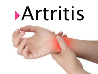 Artritis
 