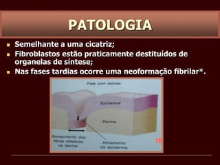  Semelhante a uma cicatriz;
 Fibroblastos estão praticamente destituídos de
organelas de síntese;
 Nas fases tardias ocorre uma neoformação fibrilar*.
PATOLOGIA
 