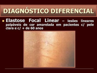  Elastose Focal Linear – lesões lineares
palpáveis de cor amarelada em pacientes c/ pele
clara e c/ + de 60 anos
DIAGNÓSTICO DIFERENCIAL
 