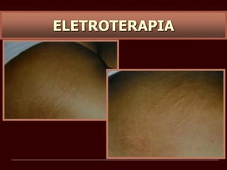 ELETROTERAPIA
 