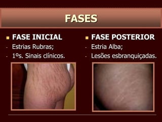  FASE INICIAL
- Estrias Rubras;
- 1ºs. Sinais clínicos.
FASES
 FASE POSTERIOR
- Estria Alba;
- Lesões esbranquiçadas.
 