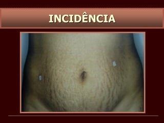 INCIDÊNCIA
 