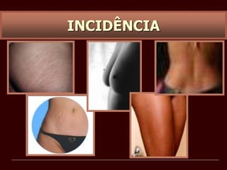 INCIDÊNCIA
 